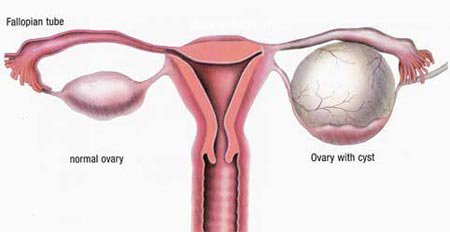  Tổng hợp các bệnh phụ khoa thường gặp ở phụ nữ