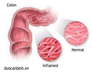 Bệnh viêm ruột hoại tử ở trẻ