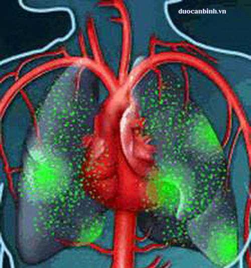  Mô phỏng vi khuẩn dịch hạch ở phổi.