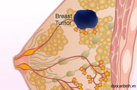 Các giai đoạn phát triển của bệnh ung thư vú