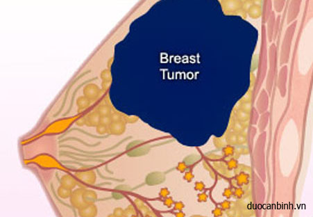 Các giai đoạn phát triển của bệnh ung thư vú