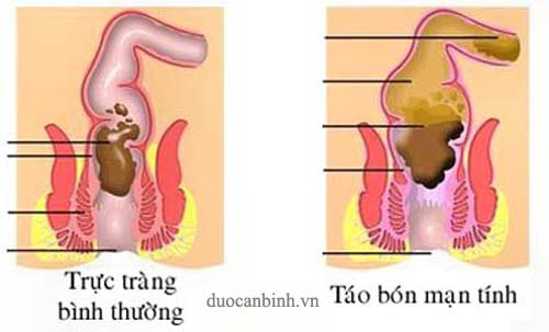 Cách%20chữa%20táo%20bón%20hiệu%20quả