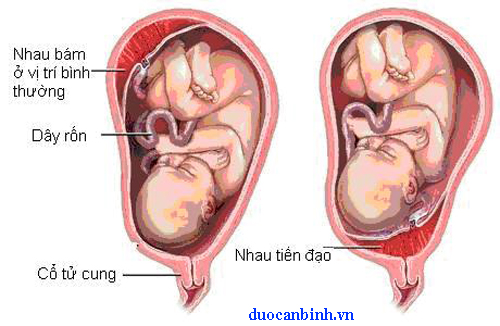 Nhau thai tiền đạo chủ yếu gây chảy máu ở cuối thai kỳ, khiến thai phụ dễ bị sinh non 