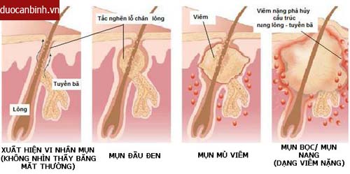 bệnh mụn trứng cá