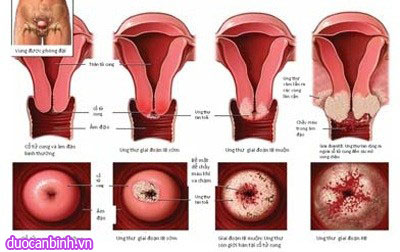 Các giai đoạn phát triển của bệnh ung thư cổ tử cung