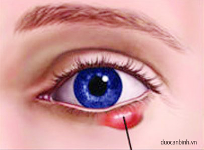 Bệnh dị ứng ở mắt