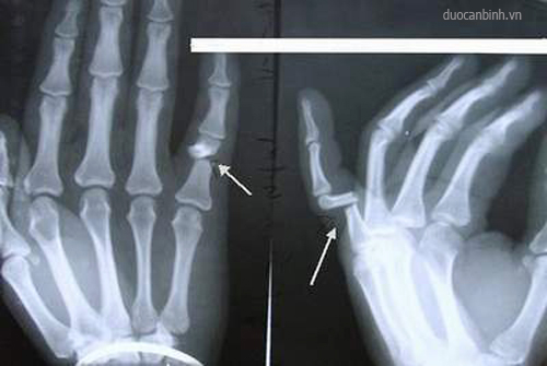 Gãy xương ngón tay là một nguyên nhân dễ dẫn đến thoái hóa khớp ngón tay.