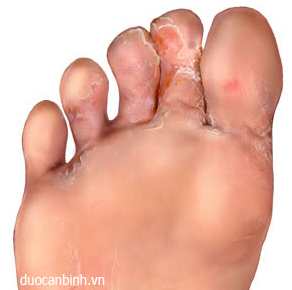 Những bệnh thường gặp ở bàn chân