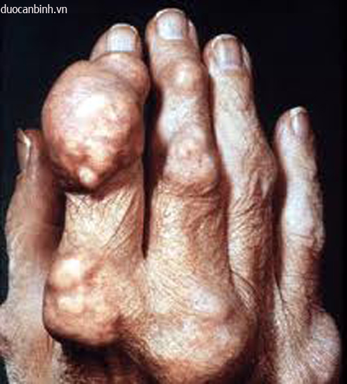 Bệnh Gout