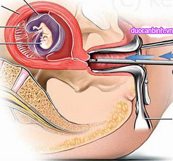 nạo phá thai nhiều gây hở eo cổ tử cung