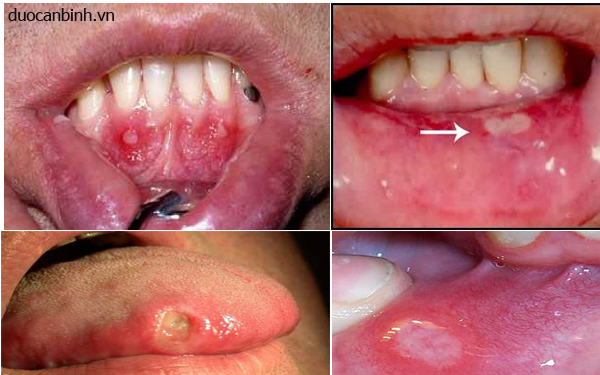 Biểu hiện của bệnh nhiệt miệng