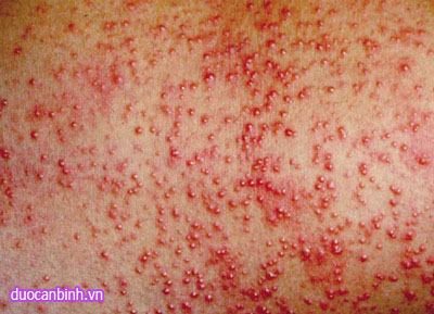 Một số bệnh da và nấm da mùa nóng