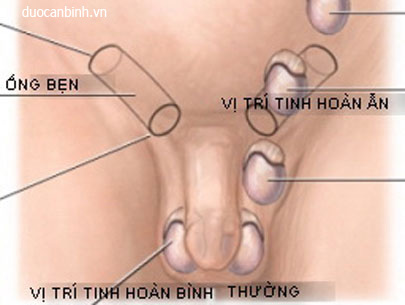 Bệnh tinh hoàn ẩn