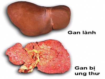 bệnh gan nhiễm mỡ