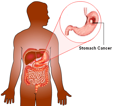 Những điều nên biết về ung thư dạ dày