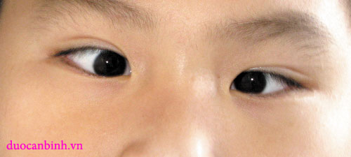 Bệnh mắt ở trẻ
