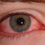Đau mắt đỏ