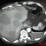 Chụp CT ung thư gan di căn