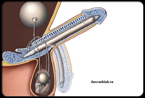 erectile-dysfunction-s20-penile-implant